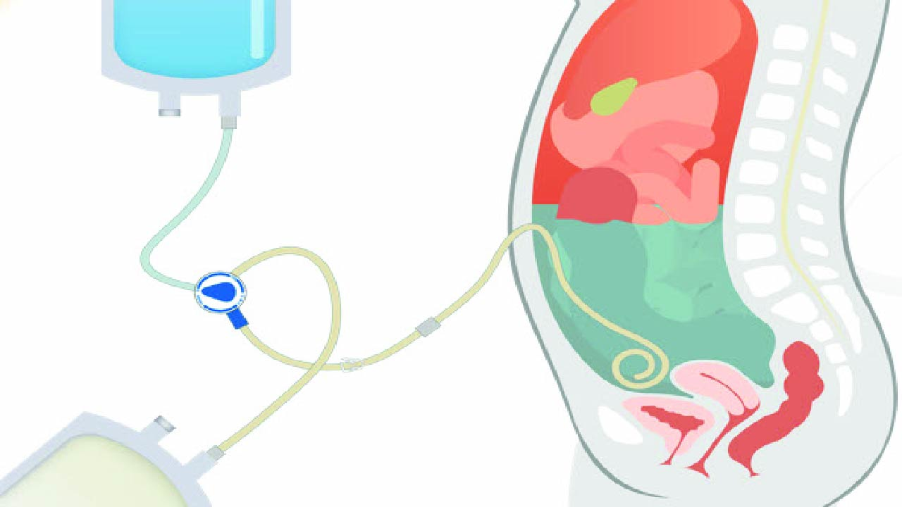 Urgent Start Peritoneal Dialysis